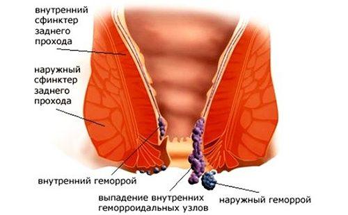 Схематично представяне на заболяването