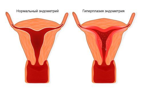 Ендометриална тъканна пролиферация